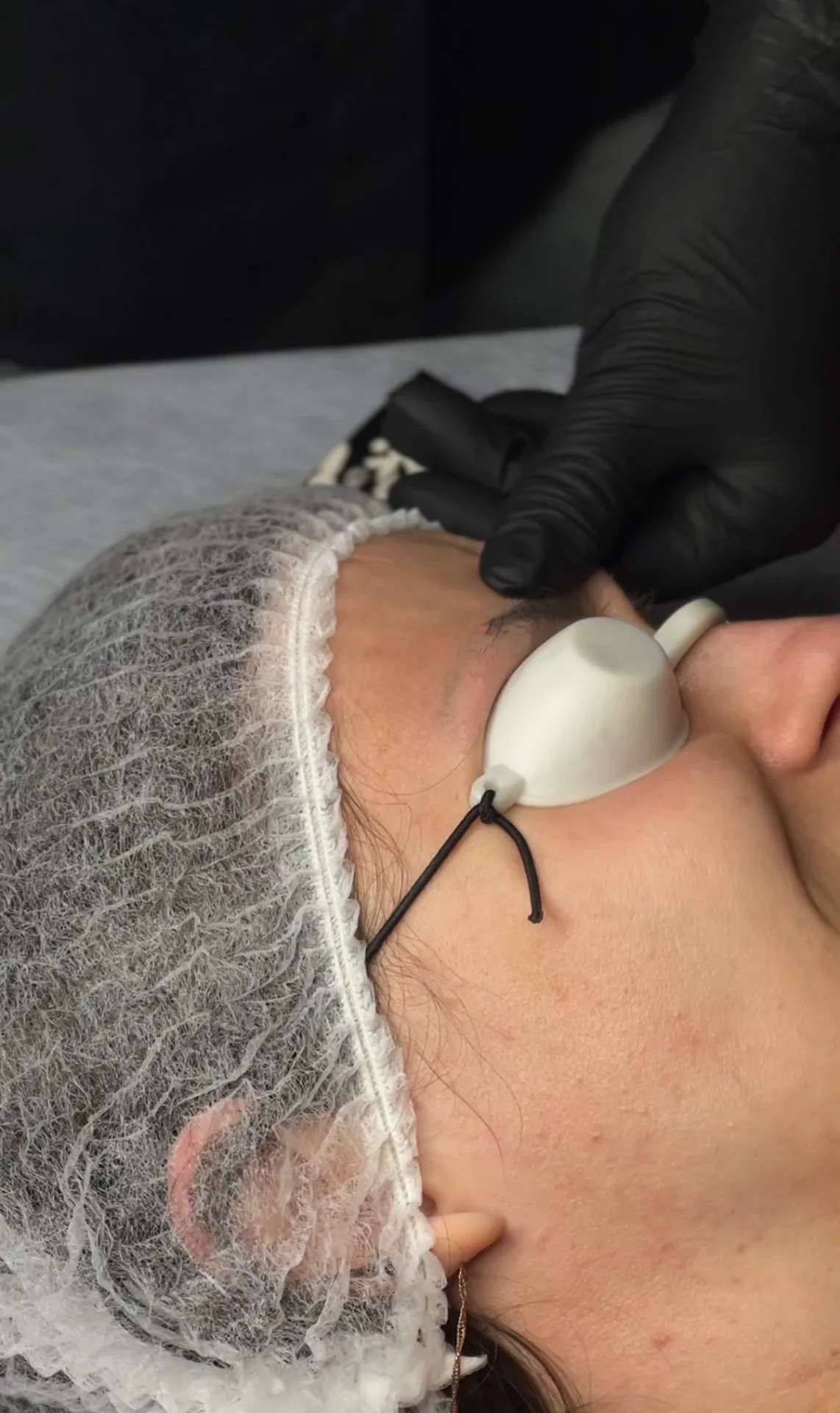 Laserowe usuwanie kresek permanentnych – KATARZYNA BRUI Salon urody Białystok – efekt zabiegu